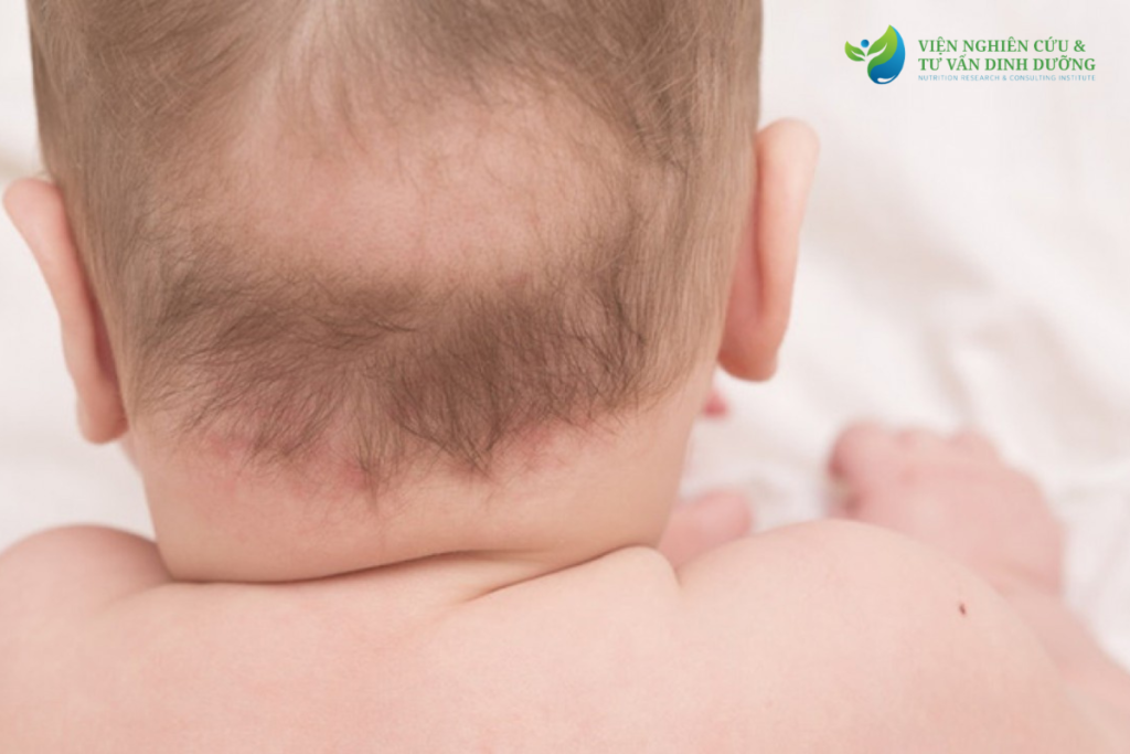 Trẻ sơ sinh bị rụng tóc trên đỉnh đầu